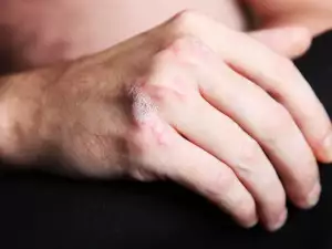 Psorijaza