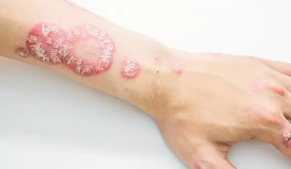 Psorijaza